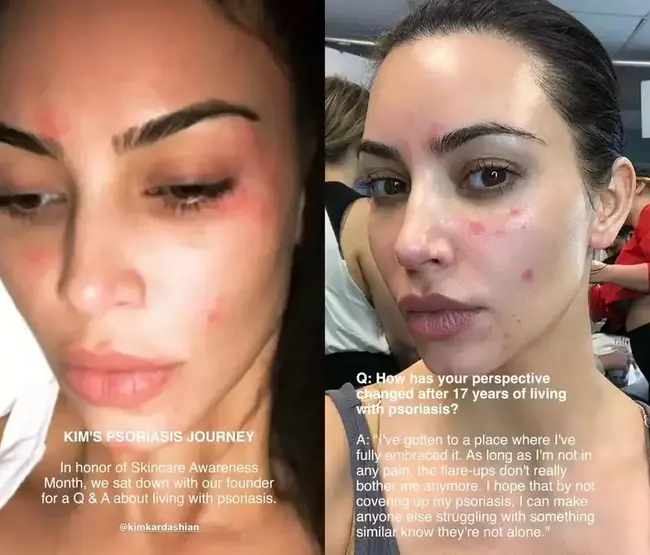 Η Κιμ Καρντάσιαν για το δερματικό πρόβλημα με την ακμή