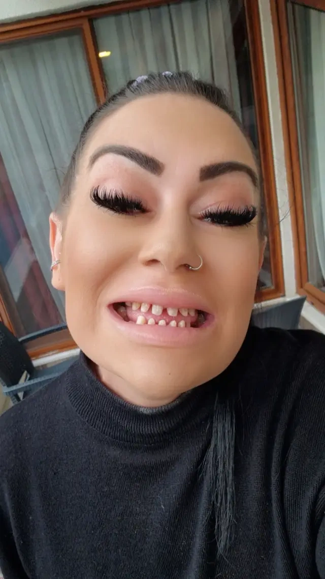 H Jackie Lynn αντιμετωπίζει σοβαρά προβλήματα μετά από προσπάθεια να βάλει νέα δόντια