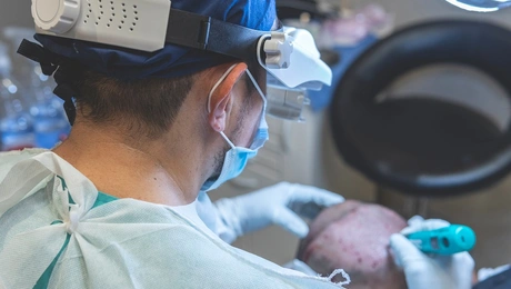 Εμφύτευση μαλλιών