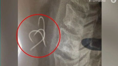 38χρονος κατάπιε αγκίστρια τρώγοντας χταπόδι