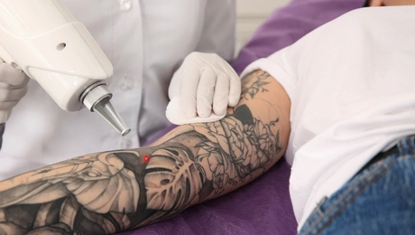 Tattoo removal