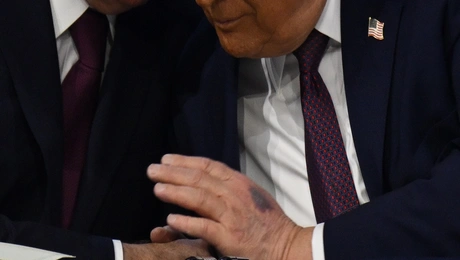 Τραμπ μελανιά