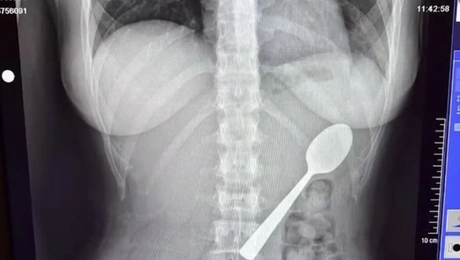 Ο υπέρηχος της 28χρονης που κατάπιε το κουτάλι