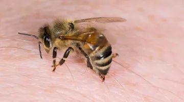 Τσίμπημα μέλισσας