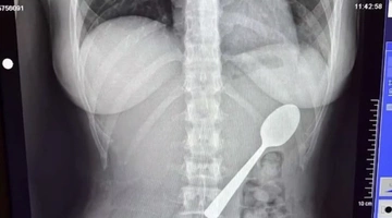 Ο υπέρηχος της 28χρονης που κατάπιε το κουτάλι